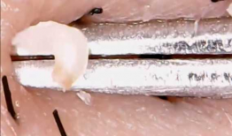 挤黑头的视频,告别毛孔堵塞烦恼